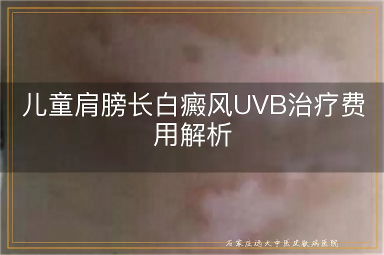 儿童肩膀长白癜风UVB治疗费用解析