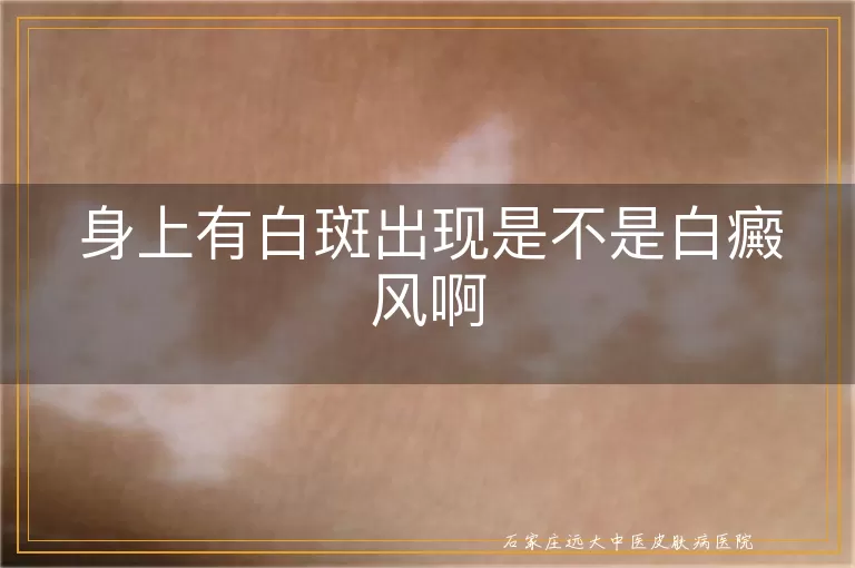 身上有白斑出现是不是白癜风啊