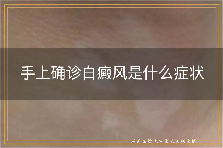 手上确诊白癜风是什么症状