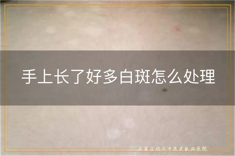手上长了好多白斑怎么处理