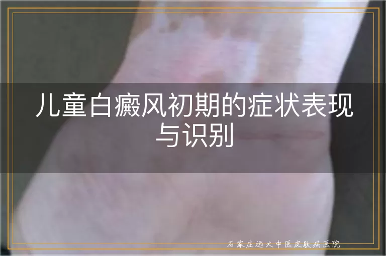 儿童白癜风初期的症状表现与识别