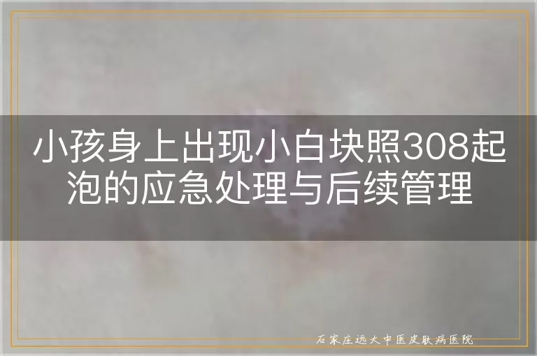 小孩身上出现小白块照308起泡的应急处理与后续管理
