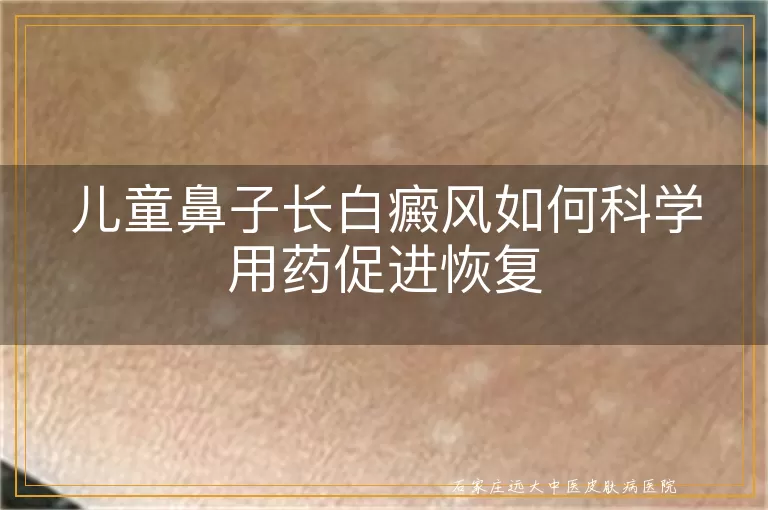 儿童鼻子长白癜风如何科学用药促进恢复