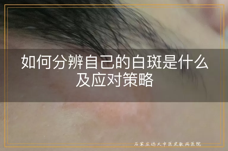 如何分辨自己的白斑是什么及应对策略
