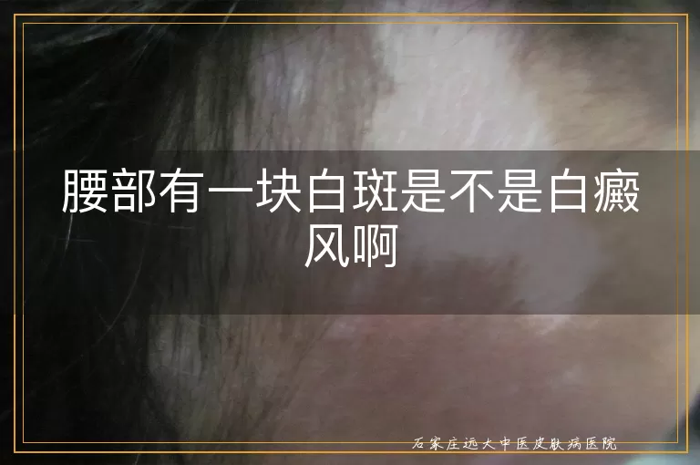 腰部有一块白斑是不是白癜风啊