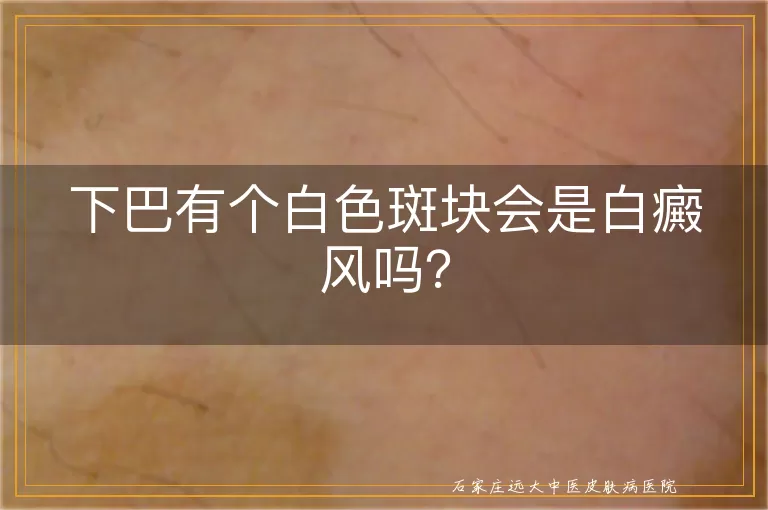 下巴有个白色斑块会是白癜风吗？