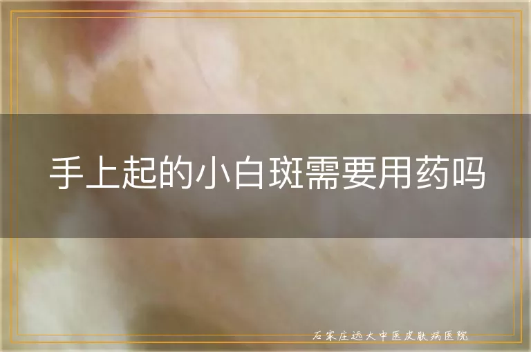 手上起的小白斑需要用药吗