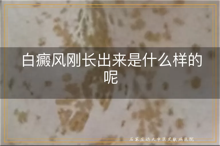 白癜风刚长出来是什么样的呢