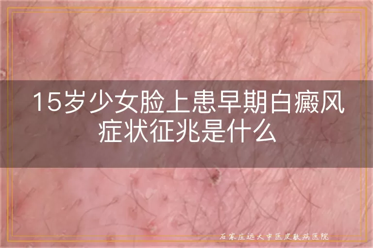 15岁少女脸上患早期白癜风症状征兆是什么