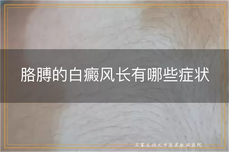 胳膊的白癜风长有哪些症状