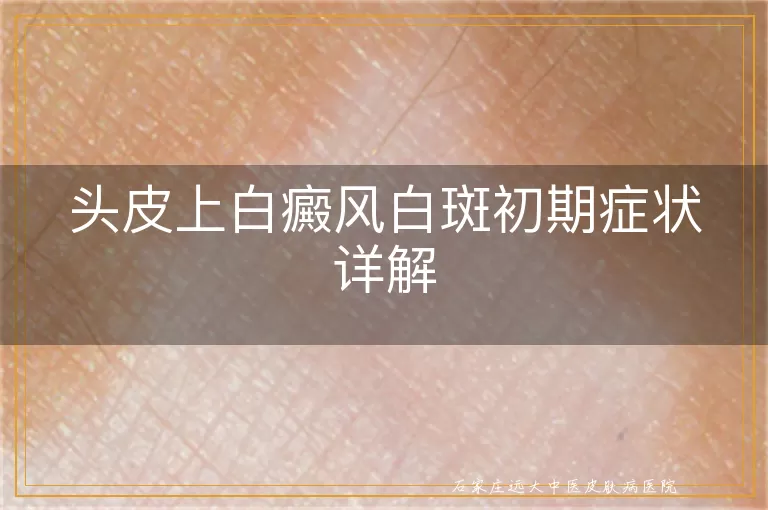 头皮上白癜风白斑初期症状详解