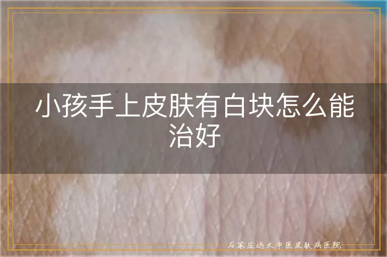 小孩手上皮肤有白块怎么能治好