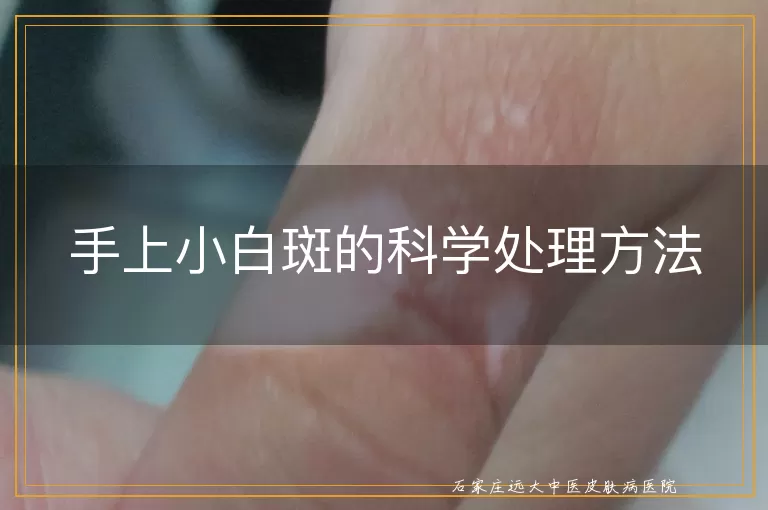 手上小白斑的科学处理方法
