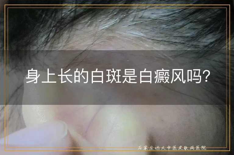 身上长的白斑是白癜风吗？