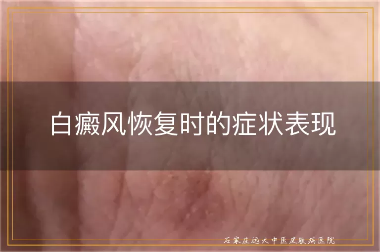 白癜风恢复时的症状表现