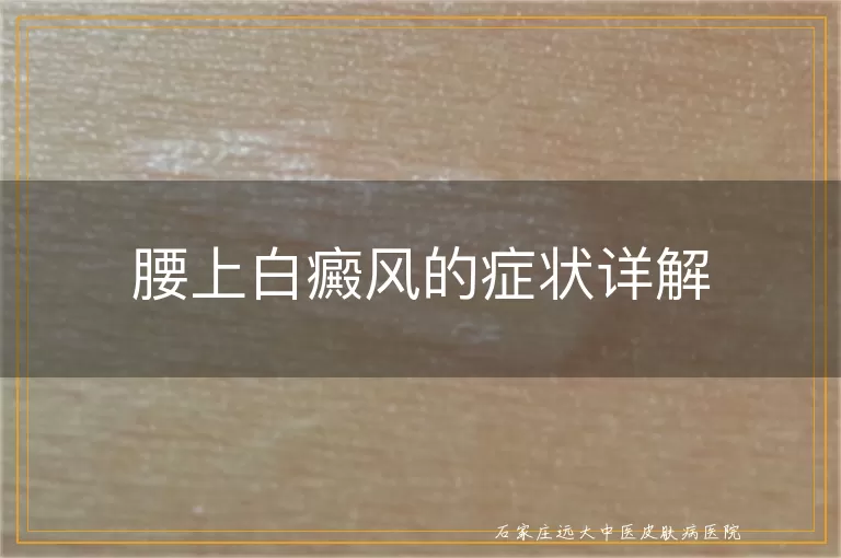 腰上白癜风的症状详解