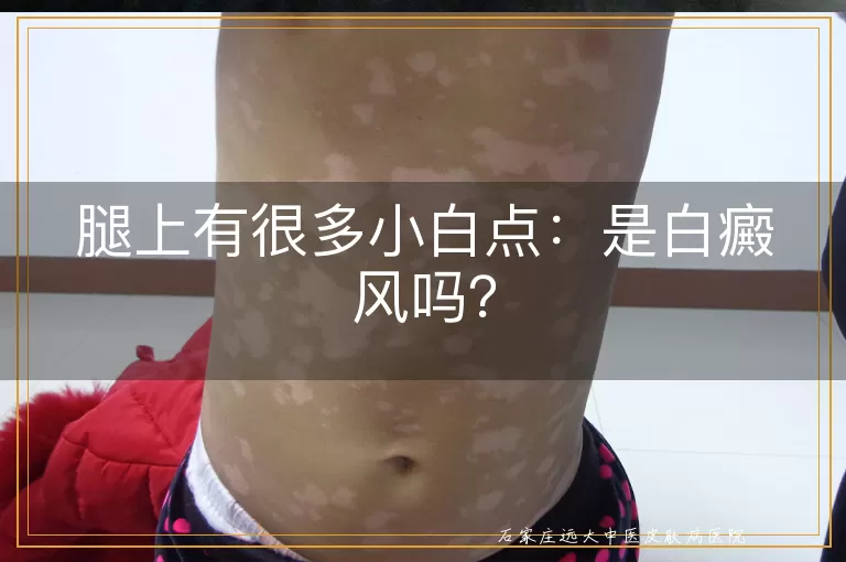 腿上有很多小白点：是白癜风吗？