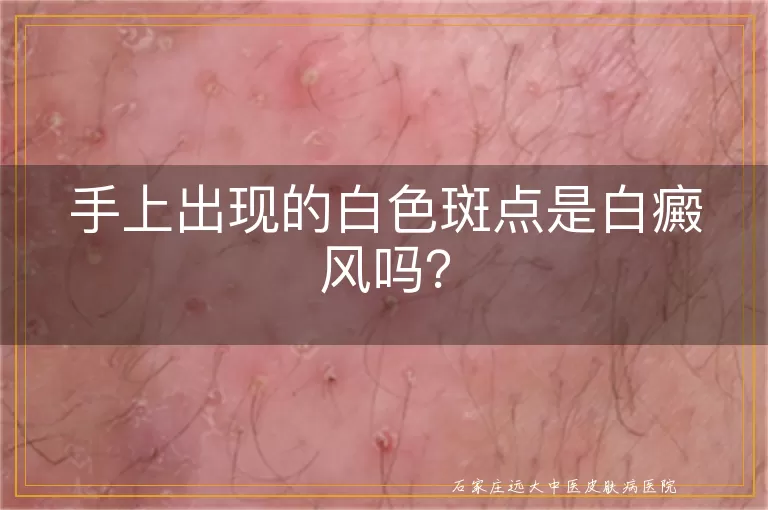 手上出现的白色斑点是白癜风吗？