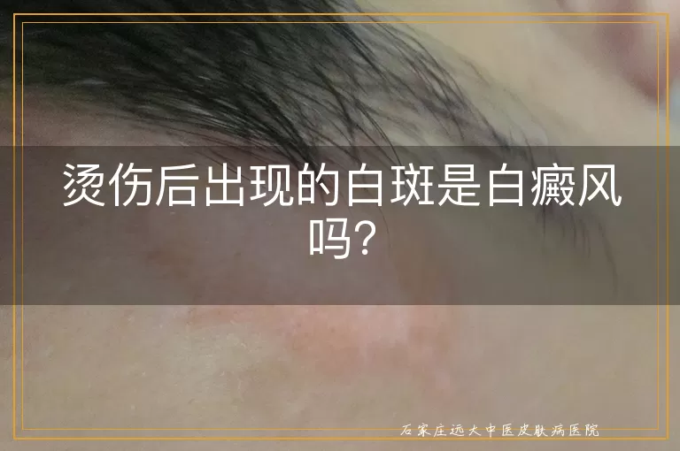 烫伤后出现的白斑是白癜风吗？