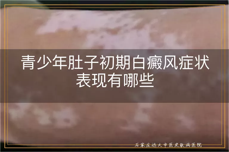 青少年肚子初期白癜风症状表现有哪些