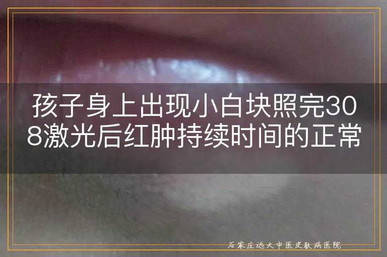 孩子身上出现小白块照完308激光后红肿持续时间的正常范围解析
