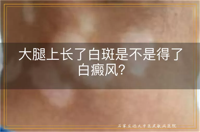 大腿上长了白斑是不是得了白癜风？