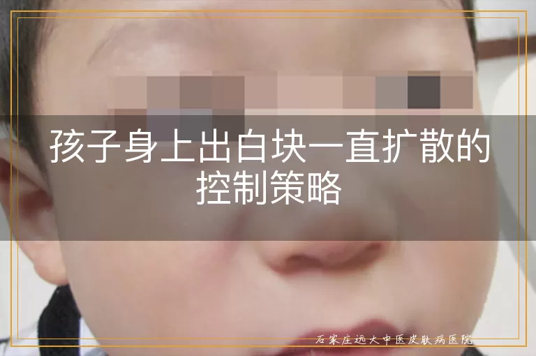 孩子身上出白块一直扩散的控制策略