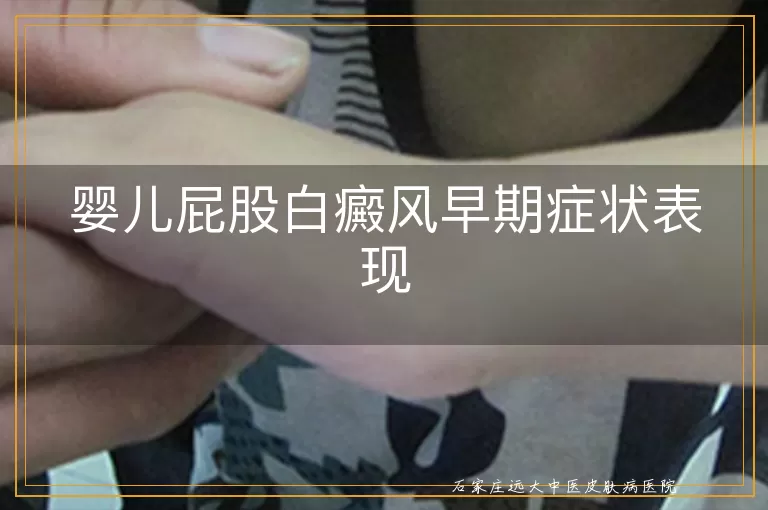 婴儿屁股白癜风早期症状表现