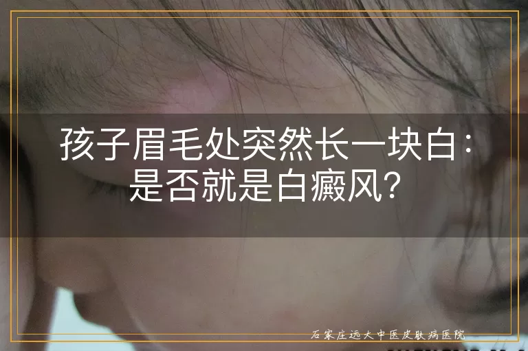 孩子眉毛处突然长一块白：是否就是白癜风？