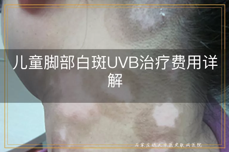 儿童脚部白斑UVB治疗费用详解