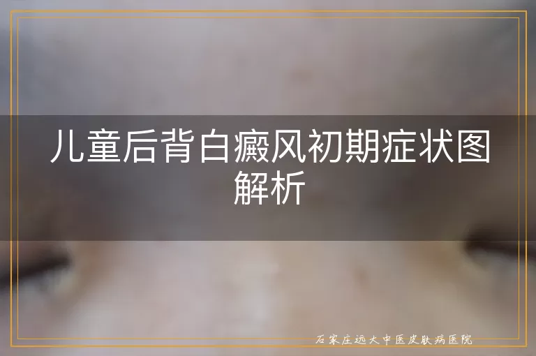 儿童后背白癜风初期症状图解析