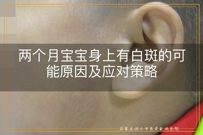 两个月宝宝身上有白斑的可能原因及应对策略