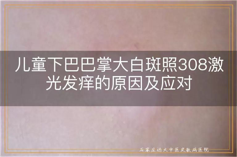 儿童下巴巴掌大白斑照308激光发痒的原因及应对