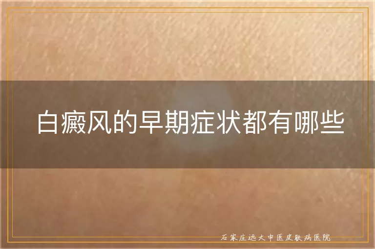白癜风的早期症状都有哪些