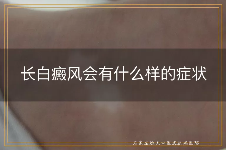 长白癜风会有什么样的症状