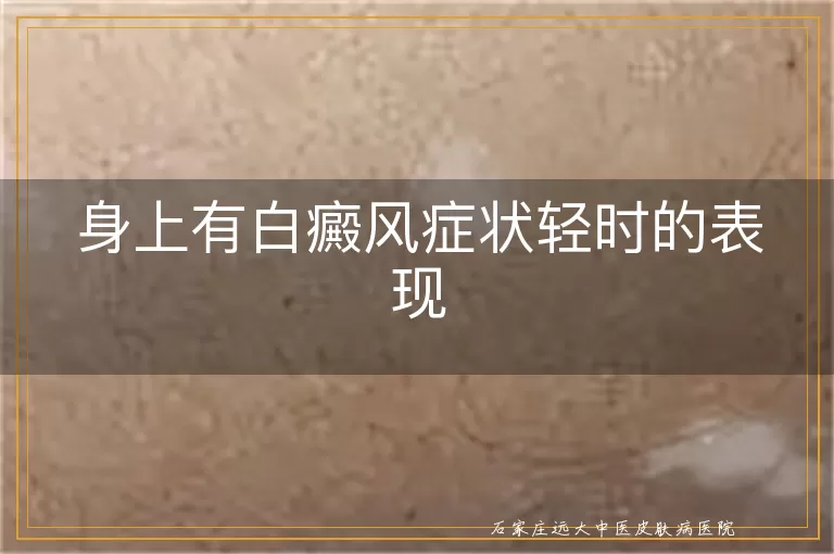 身上有白癜风症状轻时的表现