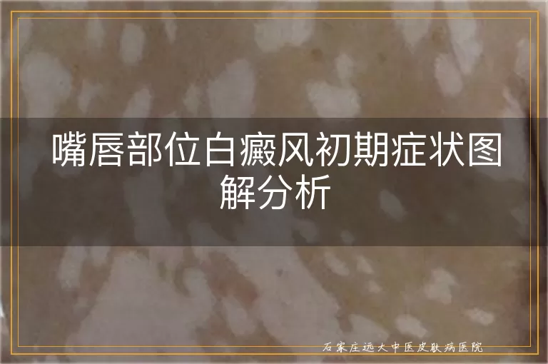 嘴唇部位白癜风初期症状图解分析