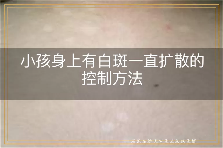 小孩身上有白斑一直扩散的控制方法