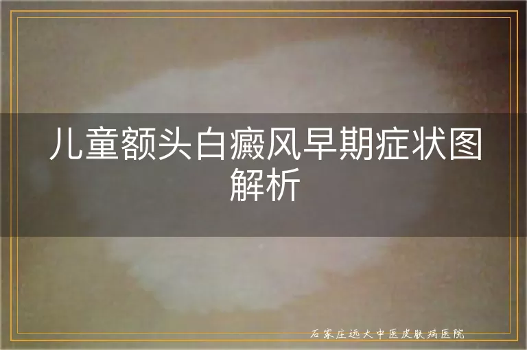 儿童额头白癜风早期症状图解析