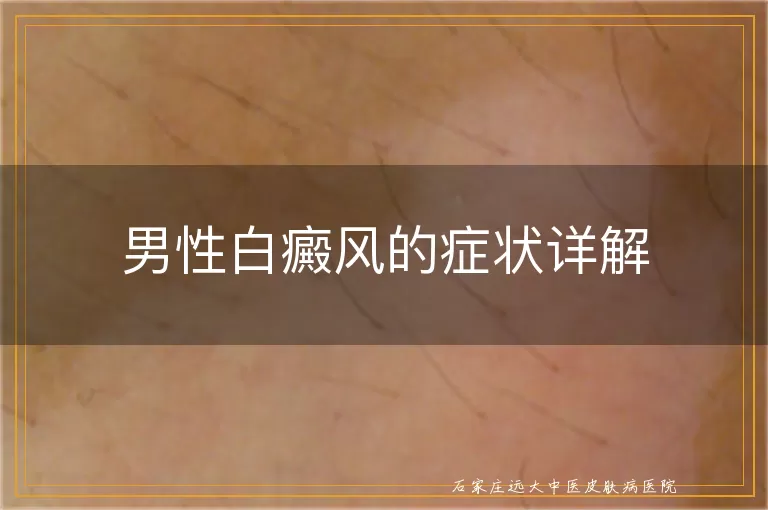 男性白癜风的症状详解