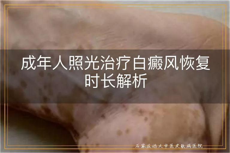 成年人照光治疗白癜风恢复时长解析