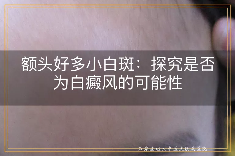 额头好多小白斑:探究是否为白癜风的可能性