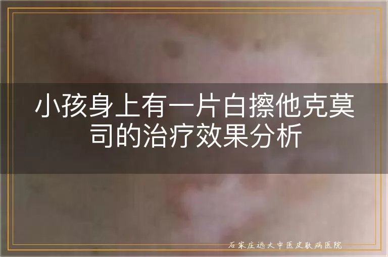 小孩身上有一片白擦他克莫司的治疗效果分析