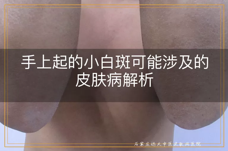 手上起的小白斑可能涉及的皮肤病解析