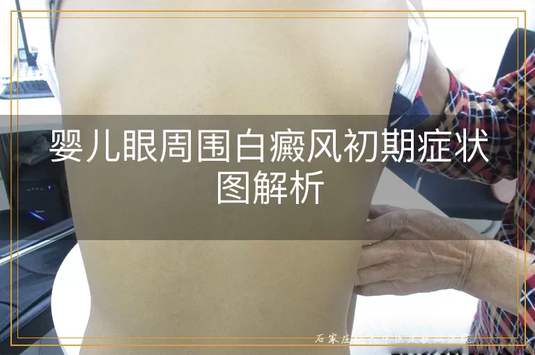 婴儿眼周围白癜风初期症状图解析