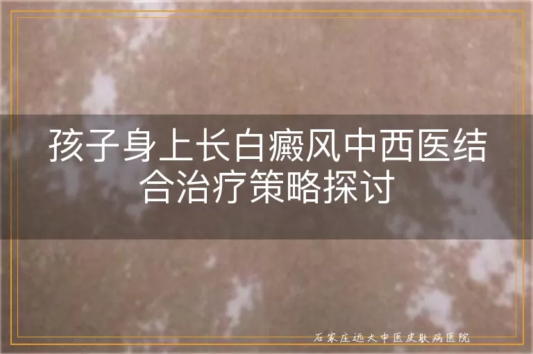 孩子身上长白癜风中西医结合治疗策略探讨