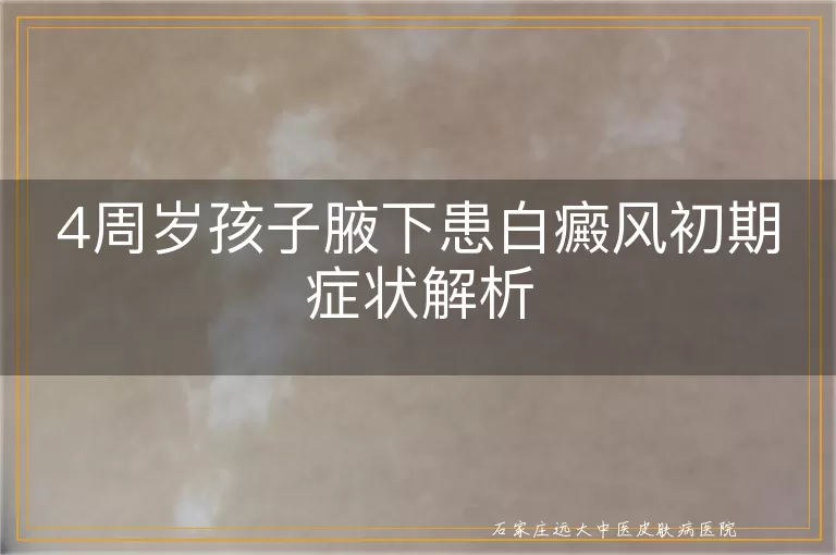 4周岁孩子腋下患白癜风初期症状解析