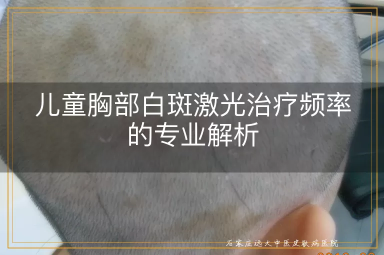 儿童胸部白斑激光治疗频率的专业解析