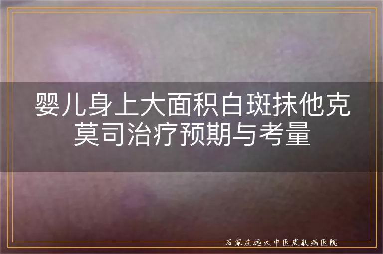 婴儿身上大面积白斑抹他克莫司治疗预期与考量