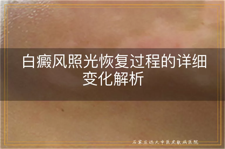 白癜风照光恢复过程的详细变化解析